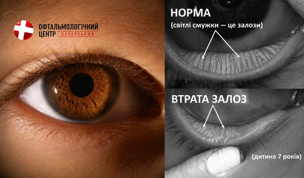 Схильність до хвороби сухого ока закладається з дитинства?