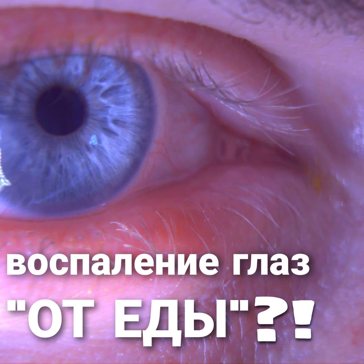 Запалення очей від їжі? Це можливо?