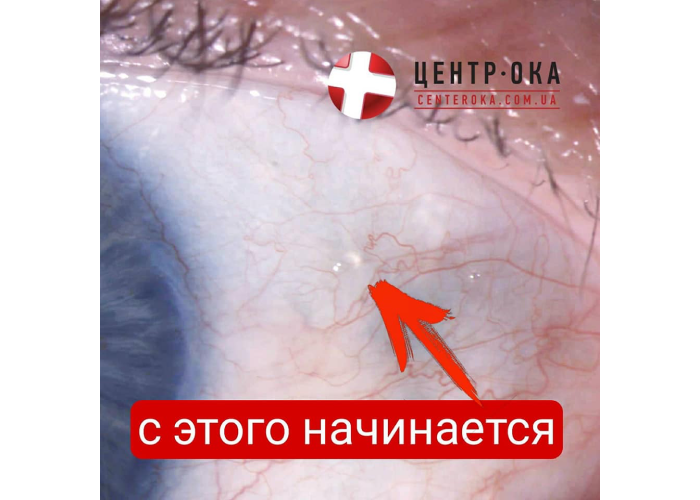 Кисты конъюнктивы