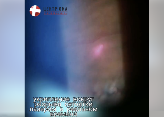 Укріплення сітківки лазером без болю за секунди (відео)