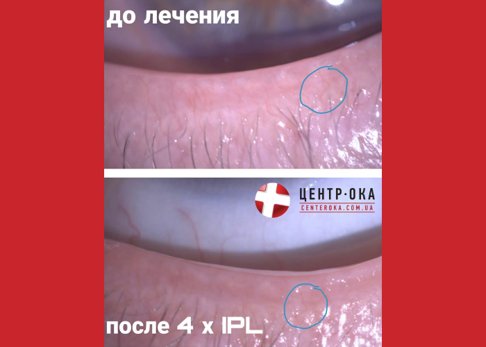 Глазная розацеа